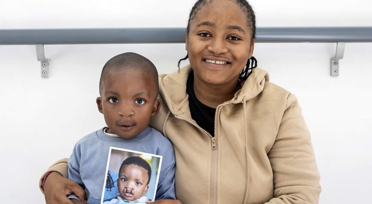 Rorisang's progress before and after cleft surgery by Operation Smile
